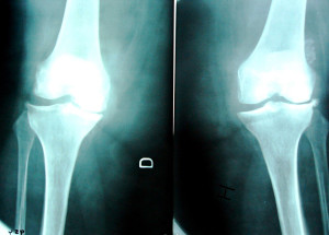 Рентгеновкий снимок сустав а пораженного артрозом
